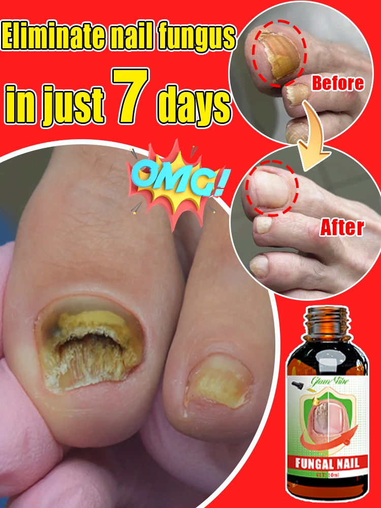 Fungus Solution Solve the Problem of Fungus