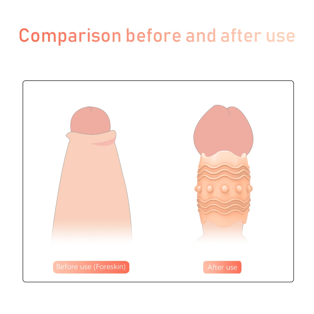Screw Foreskin Correction Shape Thress Sizes Ring Sex Toys For Men Erection Sleeve Delay Ejaculation_voghion.com