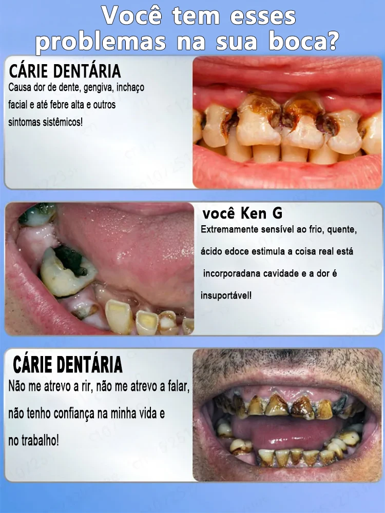 Use natural plant extracts to repair tooth decay, whiten teeth, and remove tooth decay