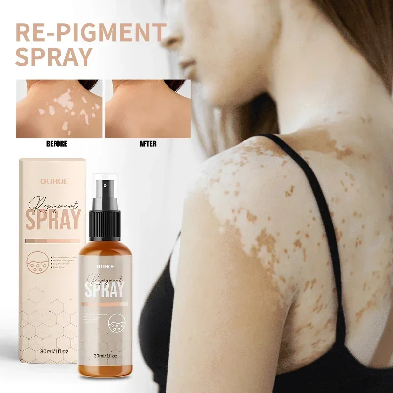 

Vitiligo spray Remove Ringworm Eliminate sweat spots lighten White Spot Removal Leukoplakia Treatment repair Skin care liquid