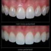 Cross Polarizing Lens for YONGNUO YN-14EX Filter for Dental Photos, Dental Photography Polar Eye Photos, No Glare, No Relfection 3