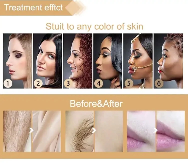 Professional Diode Painless Hair Removal 808