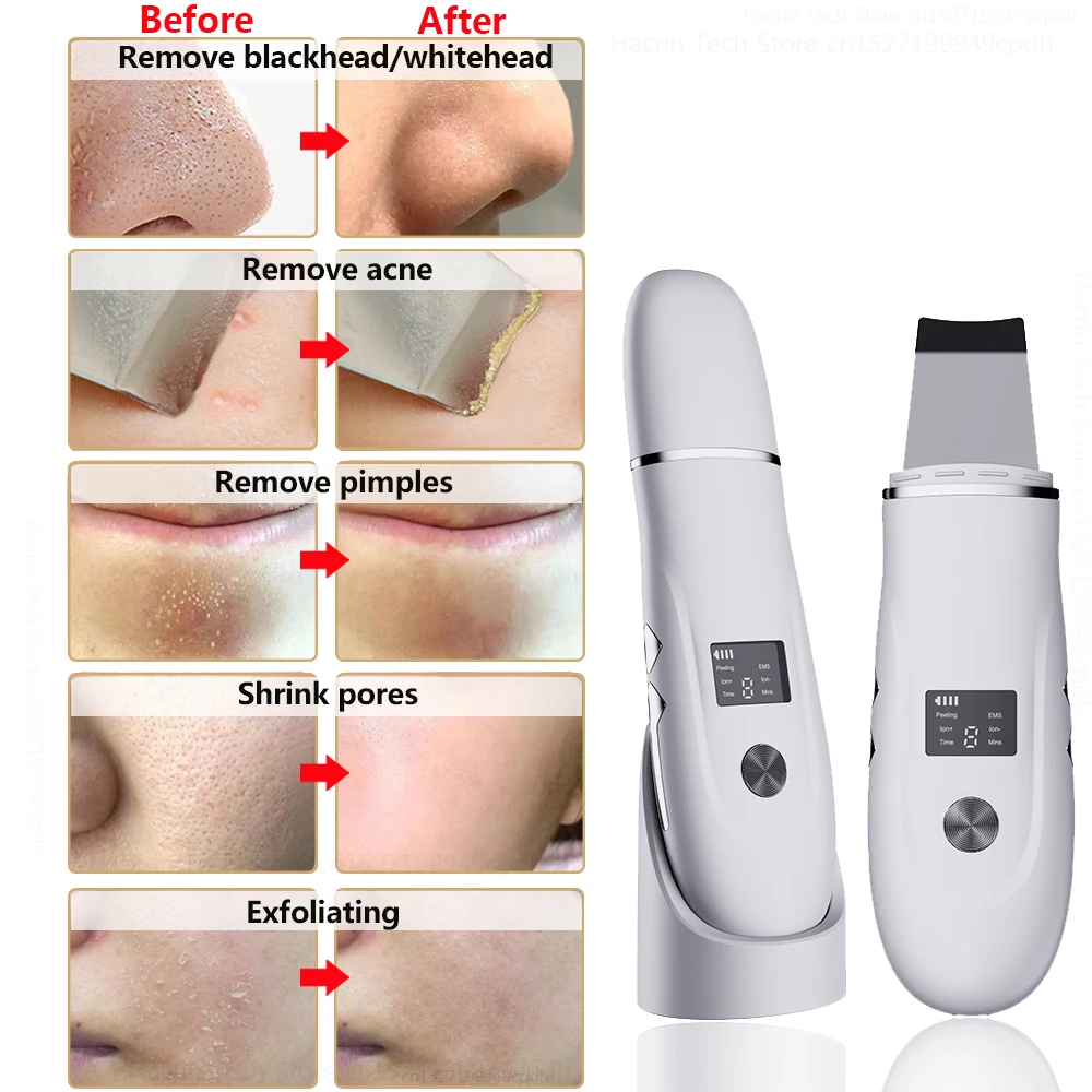 Ultrasonic Peeling Remover Blackhead Facial Skin Scrubber Facial Shovel Deep Cleaning Face Lifting Removal Pore Acne EMS Lift 6