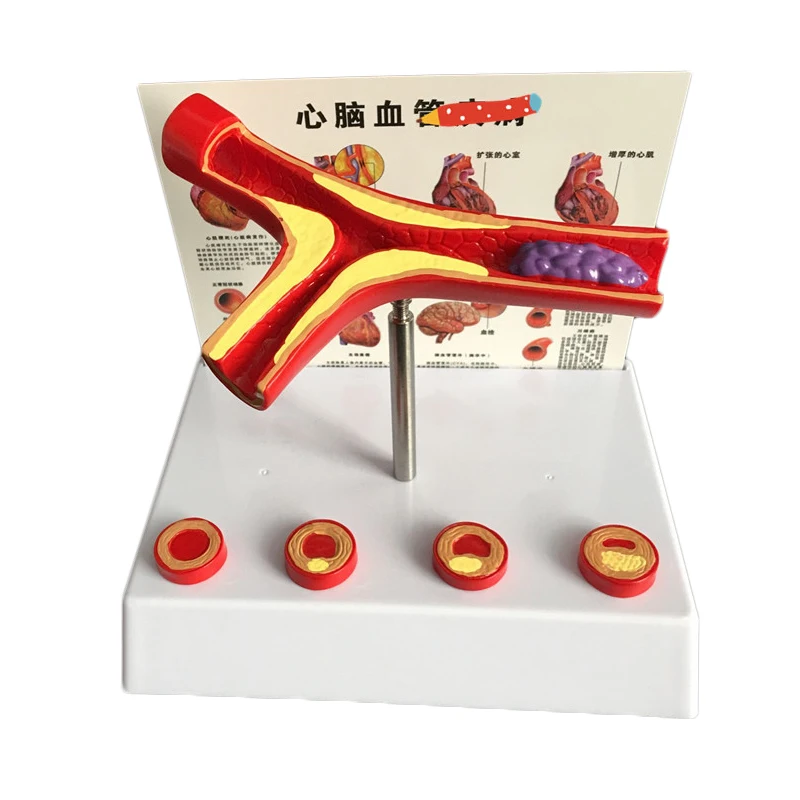 

50 Times Enlarged Human Vessel Atherosclerosis Vascular Model Lab Supplies