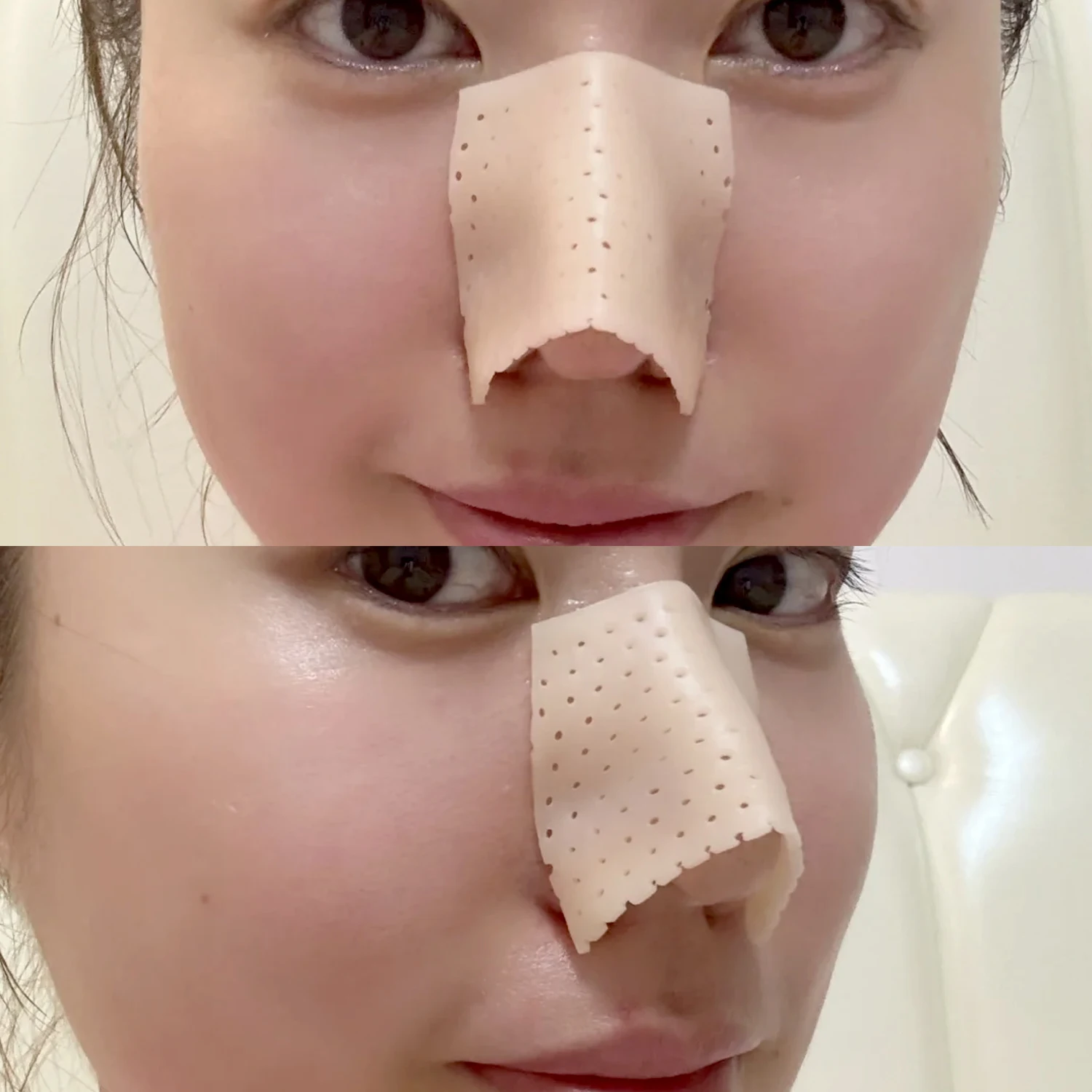 Thermoplastic Nose Splint for Fracture Support and Fixation