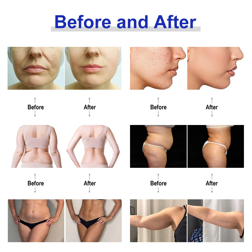 AOKO 2IN1 Tripolar Face Slimming Machine Facial Lifting Machine Body Face Massager Wrinkle Removal AntiAging Device 6