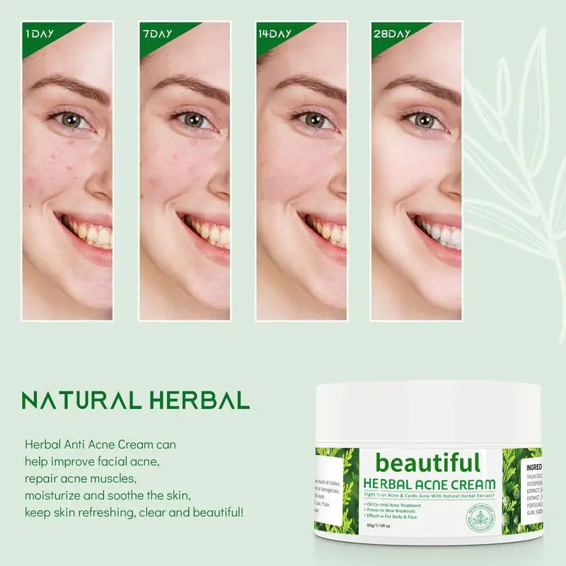 Acne removing cream, acne removing, male and female students fade acne marks, scar removing cream, pit repairing