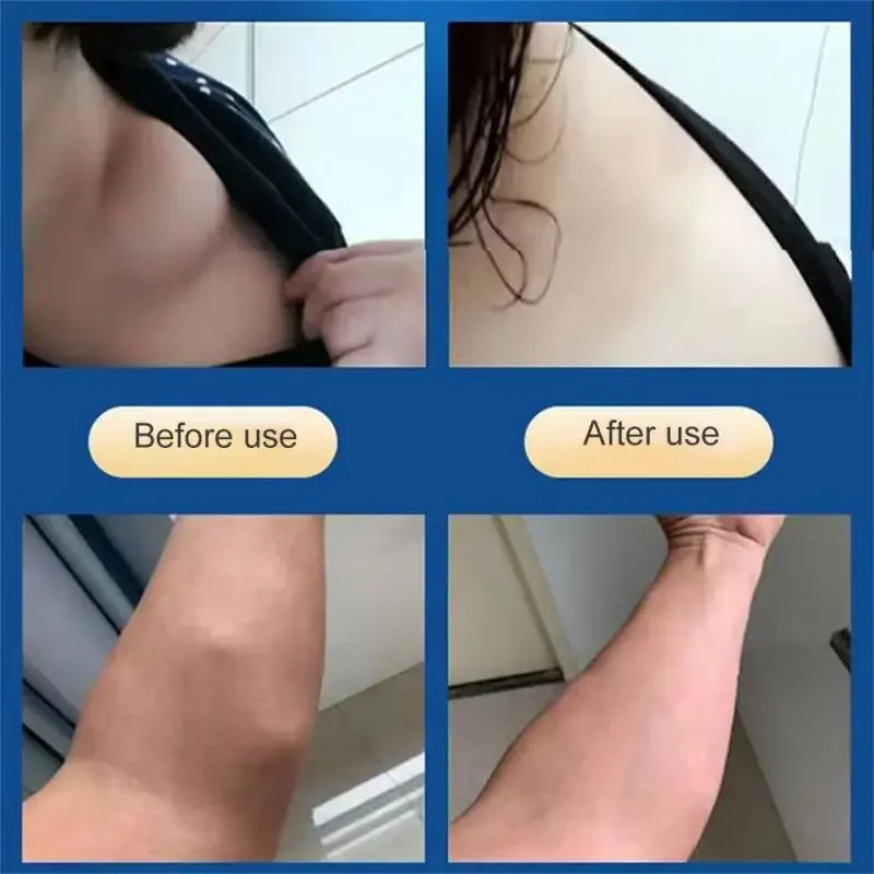 Lipoma Removal Cream 20g Relief Pain Treat Skin Swelling Lipolysis Cellulite Remover Ointment Lipolysis Fat Lump Body Care