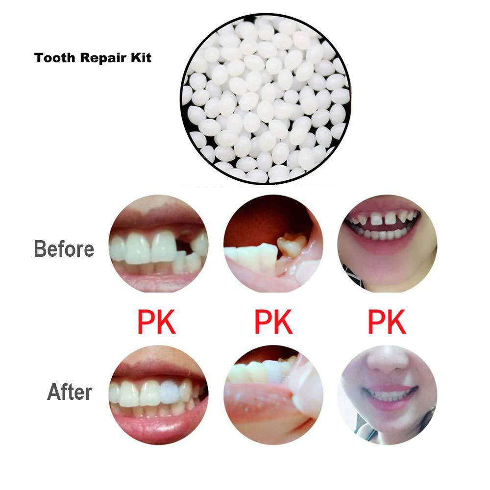 Temporary Tooth Repair Kit-Thermal Beads for Filling Fix The