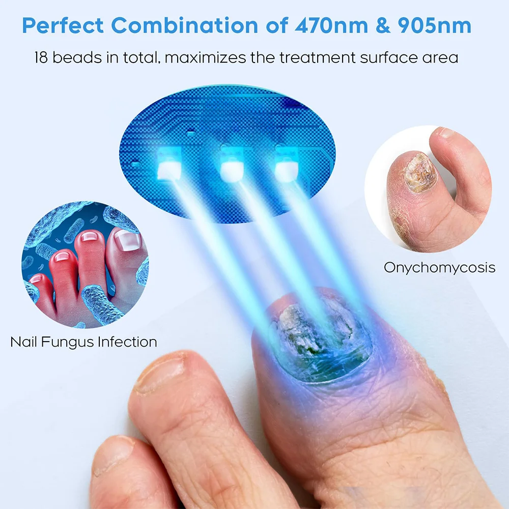 Nail Fungus Remover Personal Health Care Laser Therapy Pen Fungal Nail Laser Device Repair Fast Nails Fungus Onychomycosis Repair Toenail Fingernail Removes Nail Fungus Foot Care Device