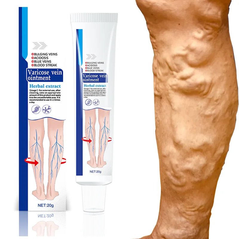 קרם טיפול בווריקוזה ואנגייטיס 100% מקורי צמחי לטיפול בווריקוזה והקלה מכאבים, קרם לטיפול בווריקוזה, פלביטיס ועכביש