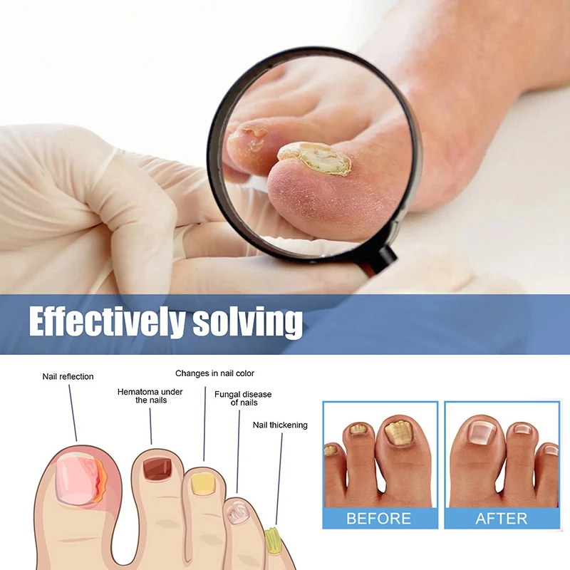 Toenail Fungus Patch Sticky Nail Repair Patch Nail Ingrown Correction Sticker Toenail Care Paronychia Treatment 60Pcs