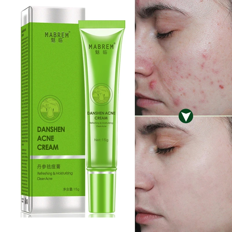 Effective Anti Acne Cream Oil Control Shrink Pore Acnes Scar Remove Acne Treatment Fade Acne