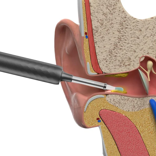 Bebird 스마트 비주얼 이어 스틱 내시경, 고정밀 귀이개 미니 카메라 검이경, 건강 관리 귀 청소기