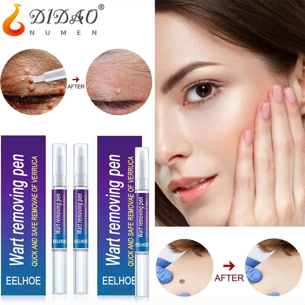 

New Wart Removal Mole Liquid Pen Treatment Papillomas Removing Skin Tags Flat Genital Warts Painless Cream Anti Verruca Remedy