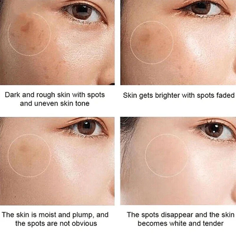 Whitening Freckles Cream Remove Melasma Dark Spot Lightening Melanin Removal Melasma Remover Moisturize Brighten Face Skin Care