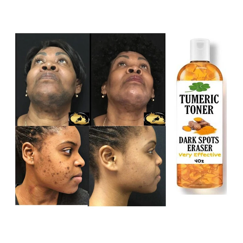 

100ml Tumeric Dark Spots Toner Facial Strong Lightening TurmericToner Spots Eraser for Even Skin Tone Flawless Skin Facial Toner