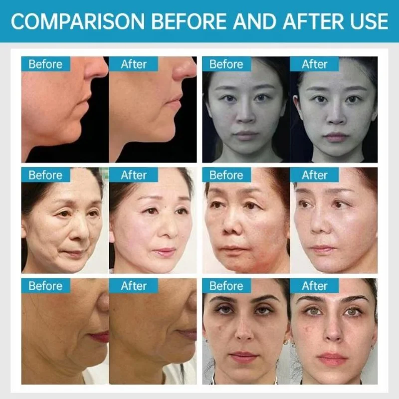 Ems Rf Peface Body Wrinkle Removal Neck Lifting Skin Tightening Rejuvenation Firming Vline Face Rejuvenation Machine