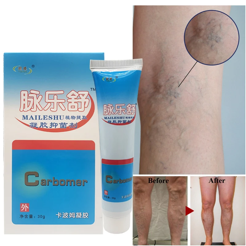 

Effective Varicose Vein Relief Cream Ointment For Varicose Veins To Relieve Vasculitis Phlebitis Spider Pain Treatment Plaster