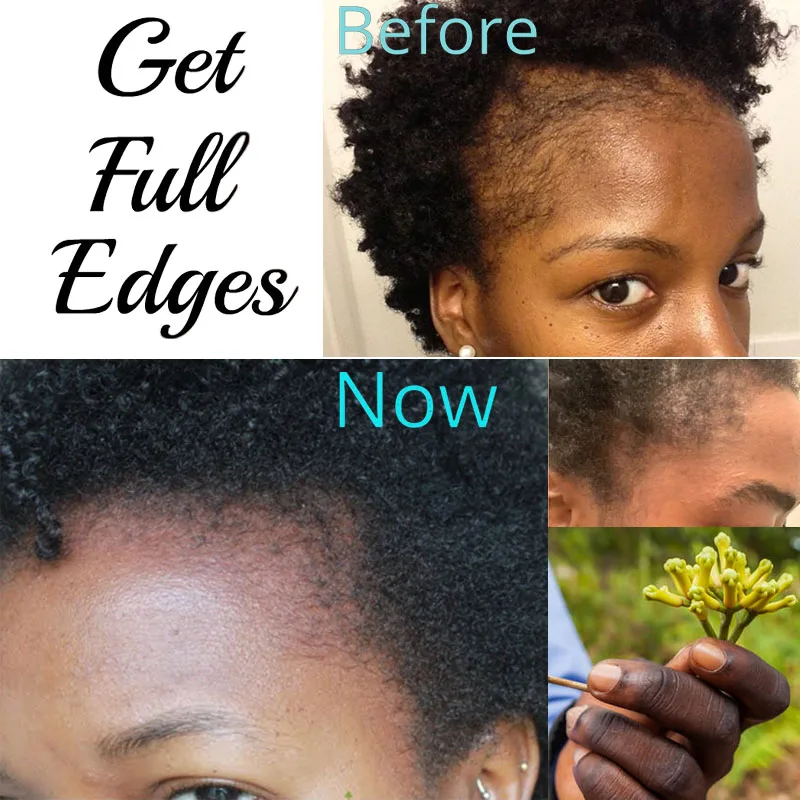 Hair Oils Solutions for Traction Alopecia Ayurvedic Herbs and Powders for Natural  Hair Growth Clove The Secret To Grow Edge Back - AliExpress