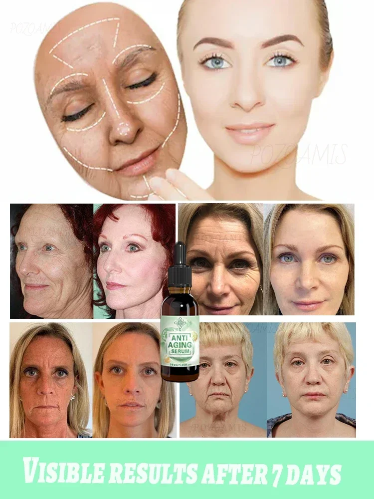 wrinkles disappear，20 years younger 4