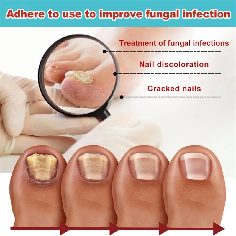 Nail Care Nail Fungal Treatment Patch Anti Infection Feet Cuticle