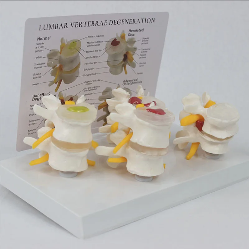 4-stage Pathological Human Lumbar Spine Anatomy Model Medical Science Teaching Resources