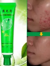  30g Face Acne Care Cream Acne Treatment Scar Removal Blemish Stretch Marks Whitening Beauty Health 