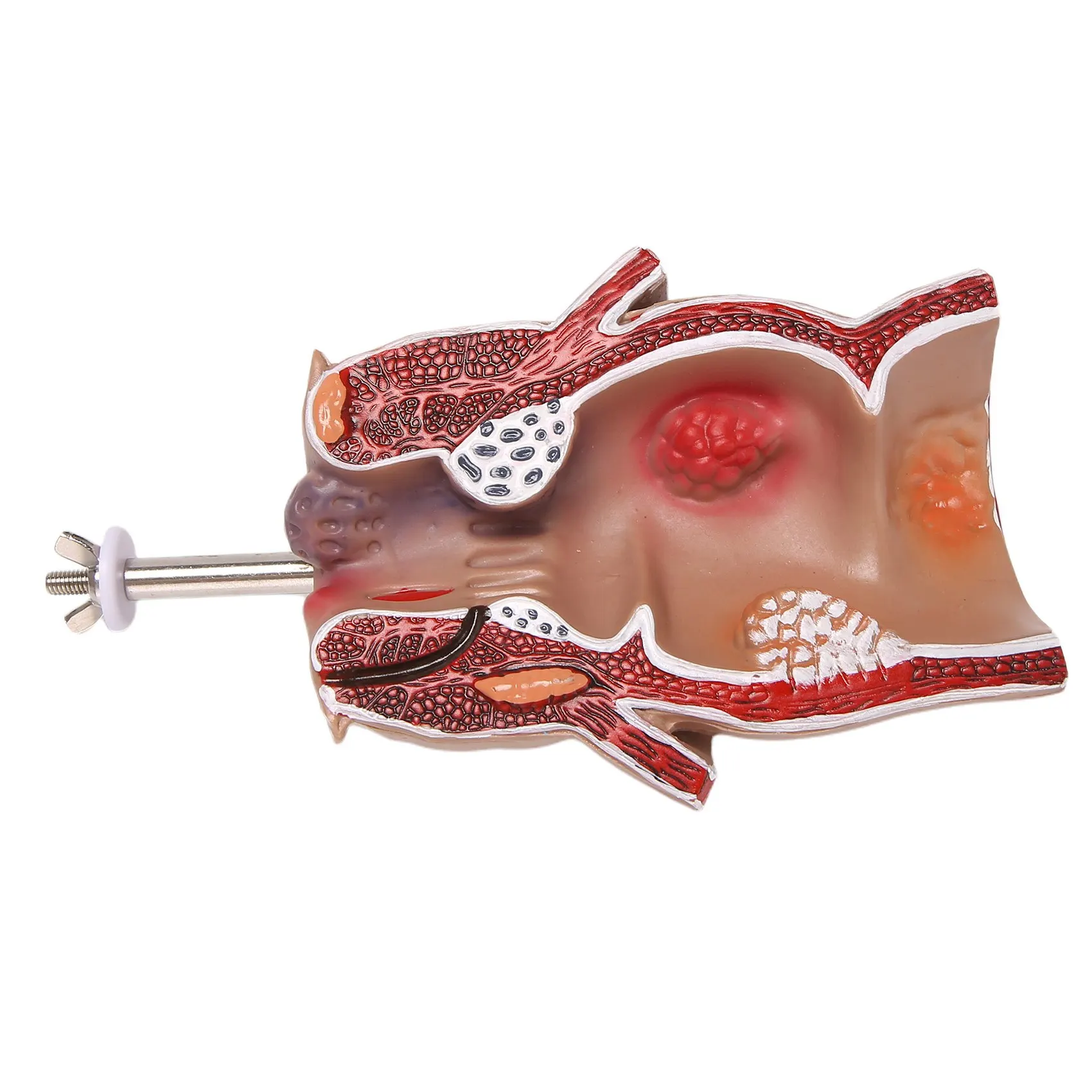 غ  ΰ  ġ   ġ ǰ Fistula fisure   