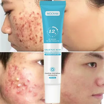Crema per l'acne per il viso Trattamento per la rimozione dei brufoli Ridurre i pori Controllo del petrolio Schiarire i segni dell'acne Sbiancamento Levigante Cura della pelle del viso