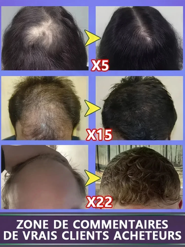 Revive Hair Strong Penetration Activate Hair Roots More Hair Say Goodbye to Baldness Thick Hair hair growth serum hair building powder hair building fibers hair growth spray hair growth cream hair growth shampoo set