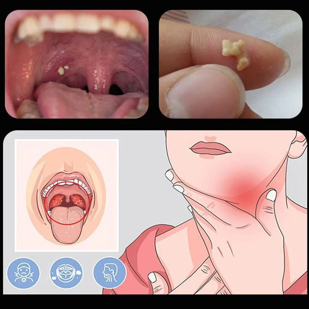 Tonsil Stone Remover Tool Suction Ball Manual Style Remover Mouth Cleaning Care Tool Ear Wax Tonsil Stone Remover Cleaning Tool 2
