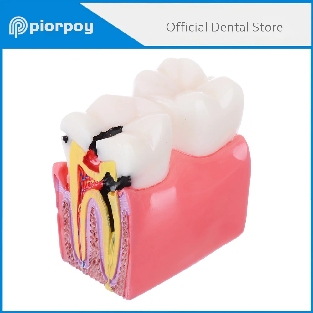 

PIORPOY 6 Times Dental Caries Comparsion Models Tooth Dental Study Teaching Anatomy Education Teeth Model Dentistry Tool New