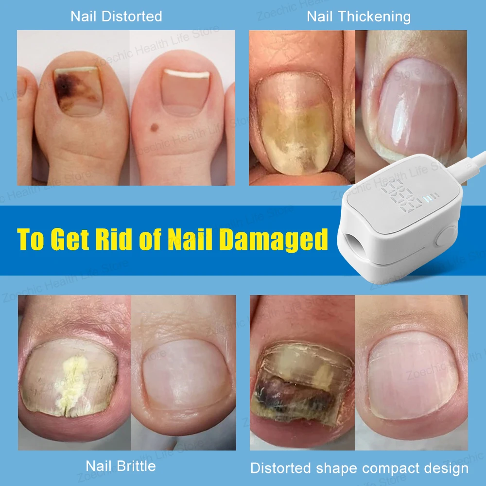 Time Display Fungal Nail Treatment Laser Device Foot Nail Repair Patch Toenail Laser Therapy Machine Ingrown Toenails Foot Care