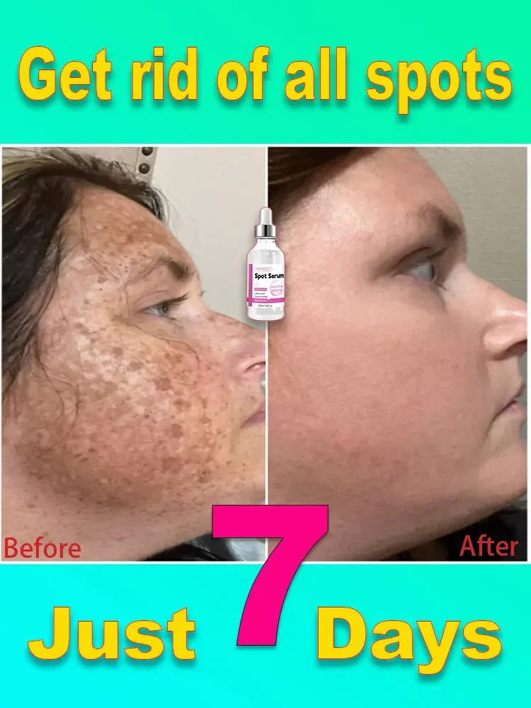 Anti-freckle serum restores skin collagen Remove facial spots, dark spots, chloasma, sun spots, whitening and freckle removal