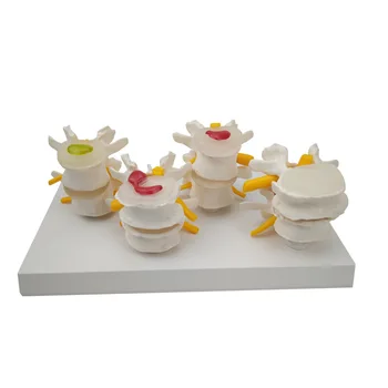 4 단계 병리 인간 요추 척추 해부학 모델, 의료 과학 교육 자료, 직송