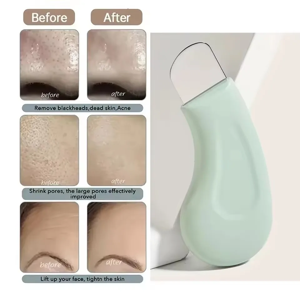 Handheld Facial Blackhead Removal Tool for Deep Cleansing