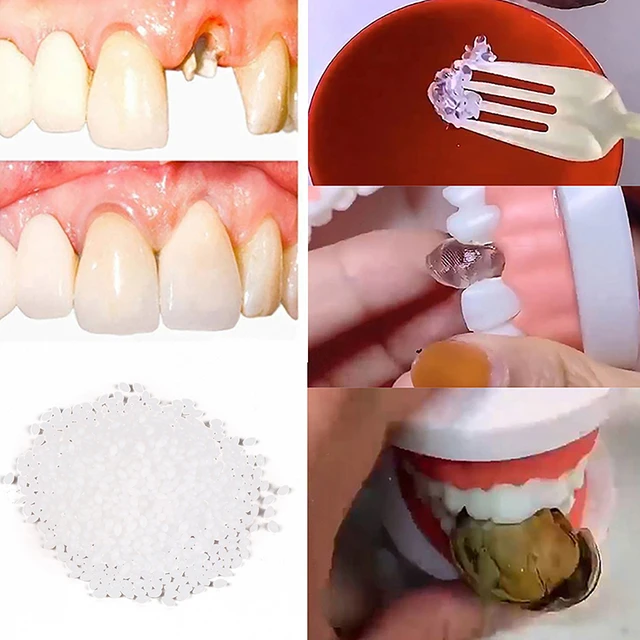 Resina 25g Kit di riparazione dei denti temporanei denti e spazi vuoti  FalseTeeth colla solida protesi adesiva sbiancamento dei denti bellezza dei  denti - AliExpress