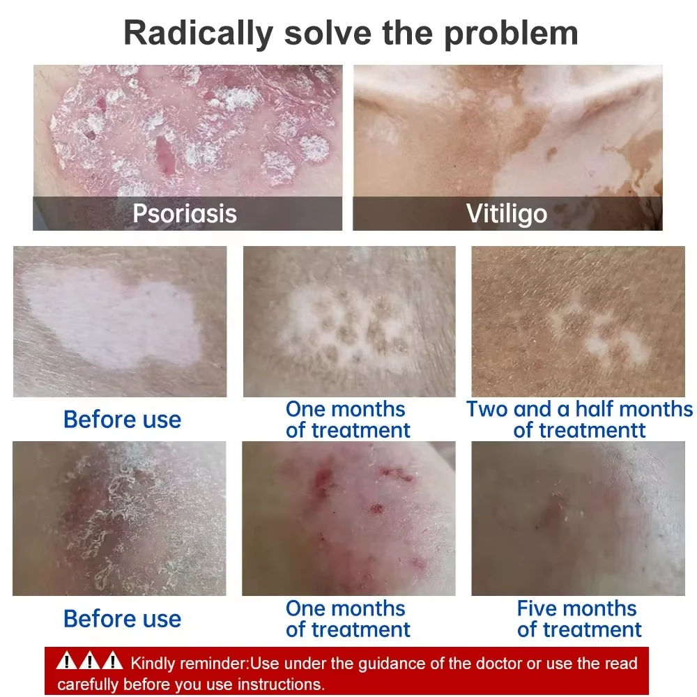 UV 311nm Ultraviolet Phototherapy Device 311nm UVB Lamp To Treat Vitiligo, Psoriasis, White Spots And Skin Disease - Image 5