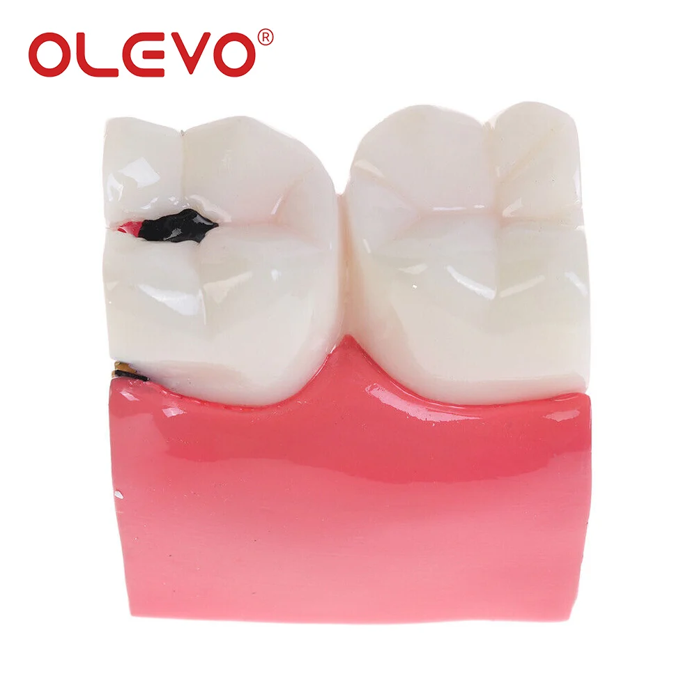 OLEVO 치과 교육 치아 모델 6 배 우식 비교 데모 학생 공부 치과 실험실 훈련 틀니 모델
