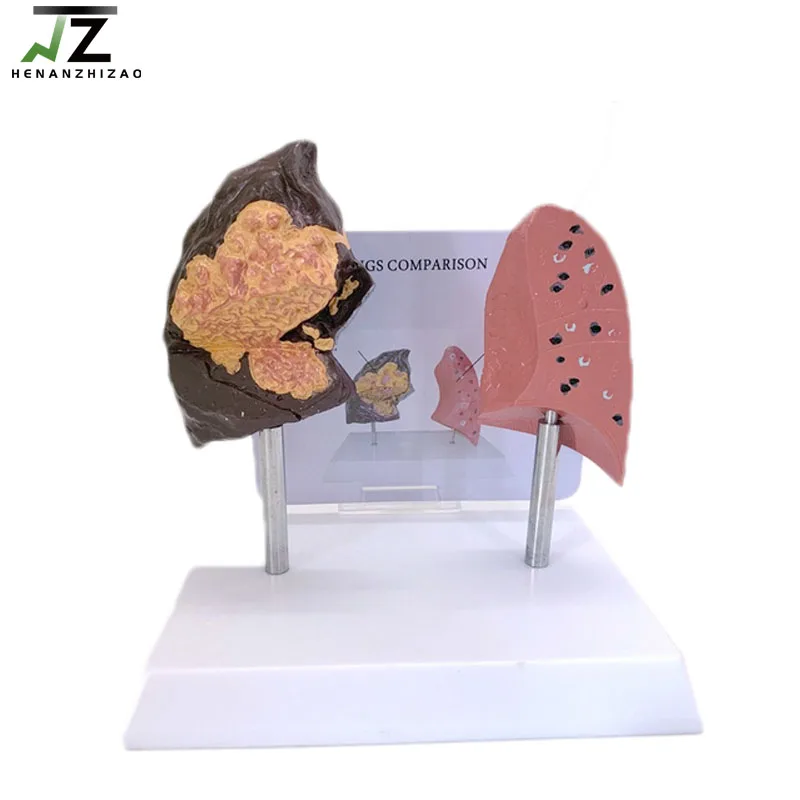 respiratory-system-human-anatomy-healthy-and-smoking-pathological-lung-comparison-model