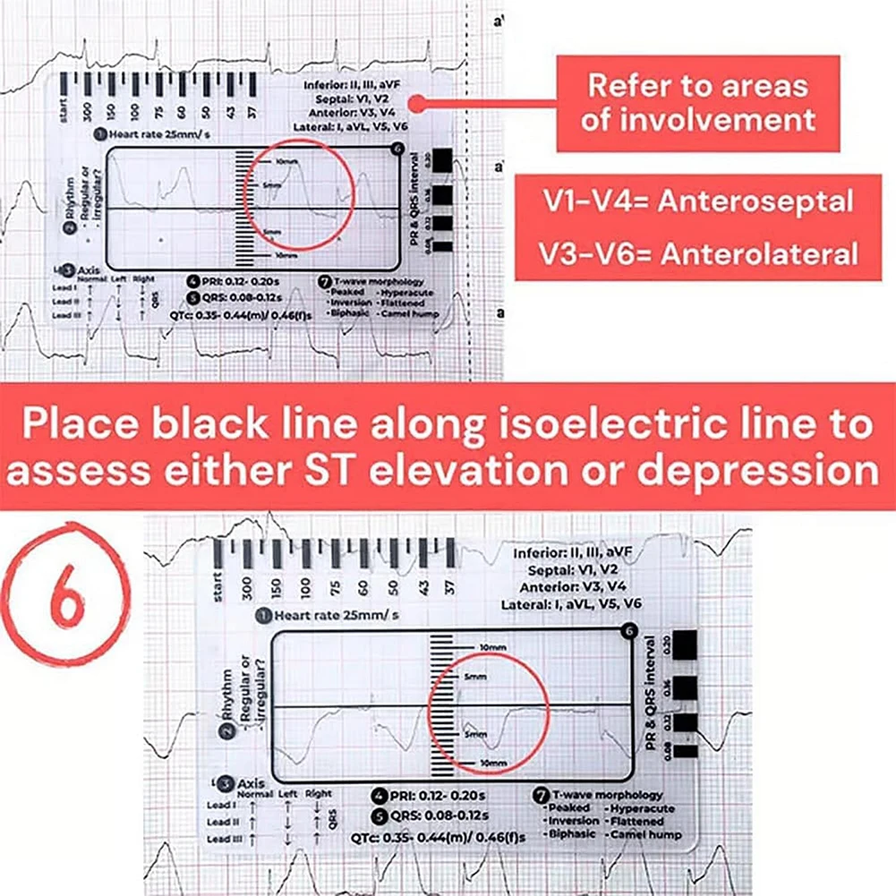 Electrocardiogram 7 Step Ruler Transparent EKG Calipers Measuring Portable Pocket ECG Nurse Easy Carry Ruler EKG Interpretation