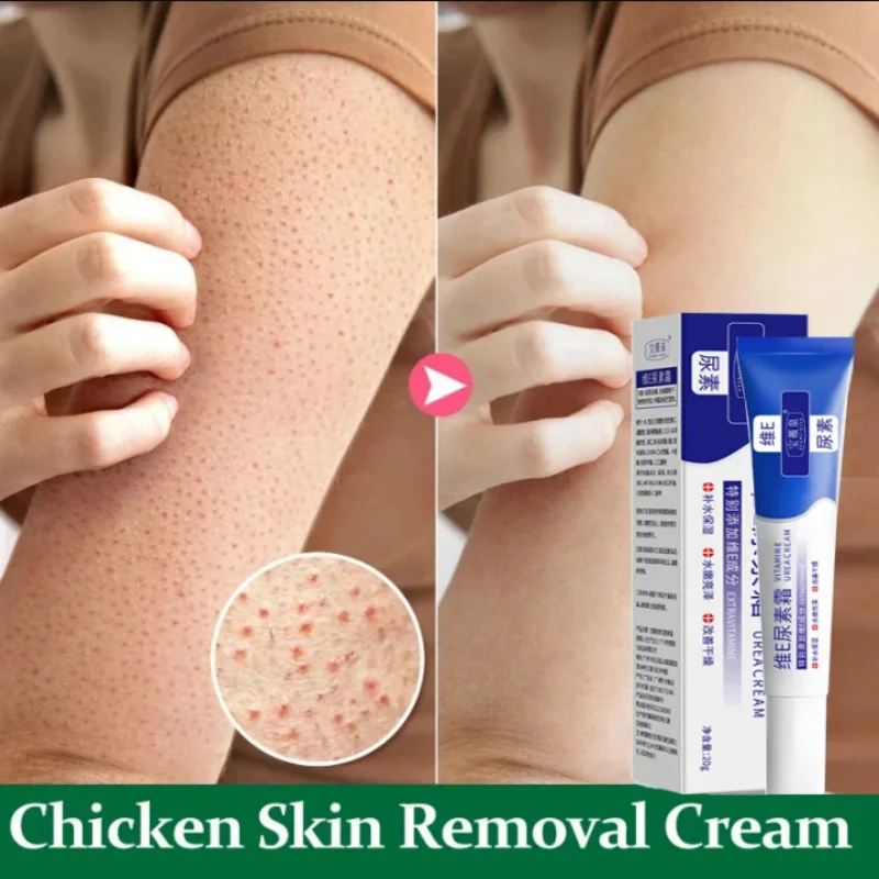 Curing Keratosis Pilaris Chicken Follicle Skin Repair Cream Body Dark Spot Remove Whiten Smooth Moisturize Skincare Body Lotion whitening body cream whitening cream body lotion brightening cream body care brightening body cream body skin care cream