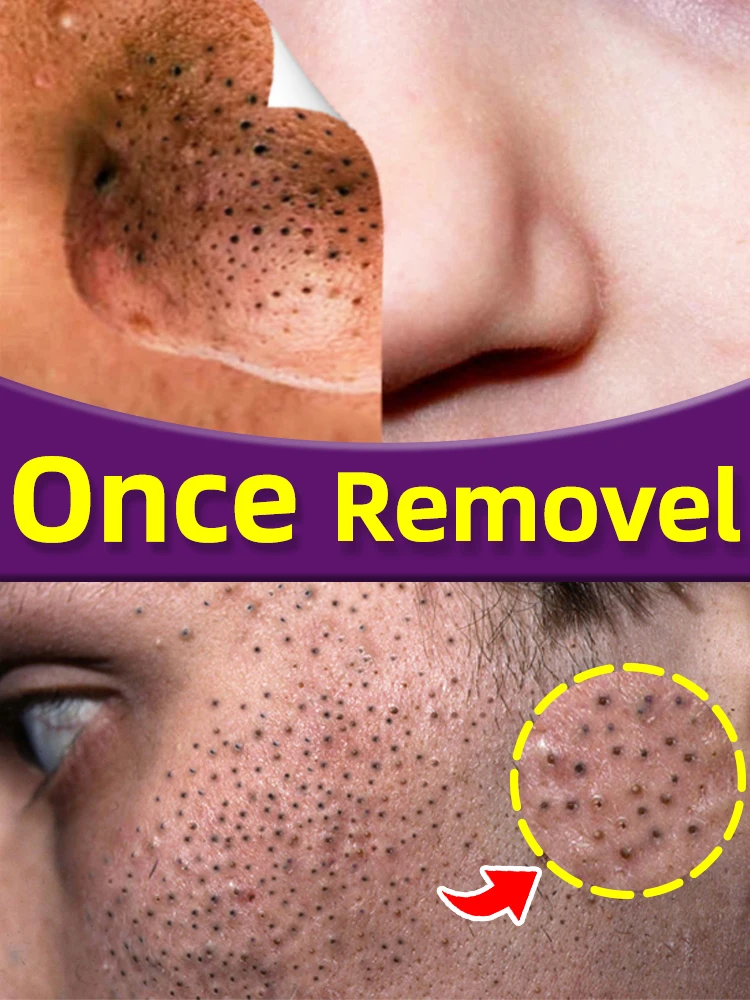BlackheadRemoverMaskBlackheadsAndPimplesRemovingCreamBlackDots