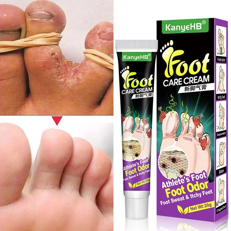 

Tinea Pedis Treatment Cream Relief Itch Pain Remove Foot Odor Inhibit Fungi Ointment Athlete's Foot Anti-itch Beauty Health Care