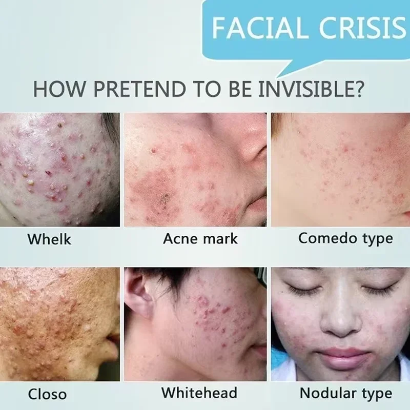 Crema restringente i pori Prodotti per la riparazione del pozzo dell'acne per uomini e donne Rimuovi le cicatrici delle smagliature dell'acne Pelle liscia antinfiammatoria dei pori grandi 2