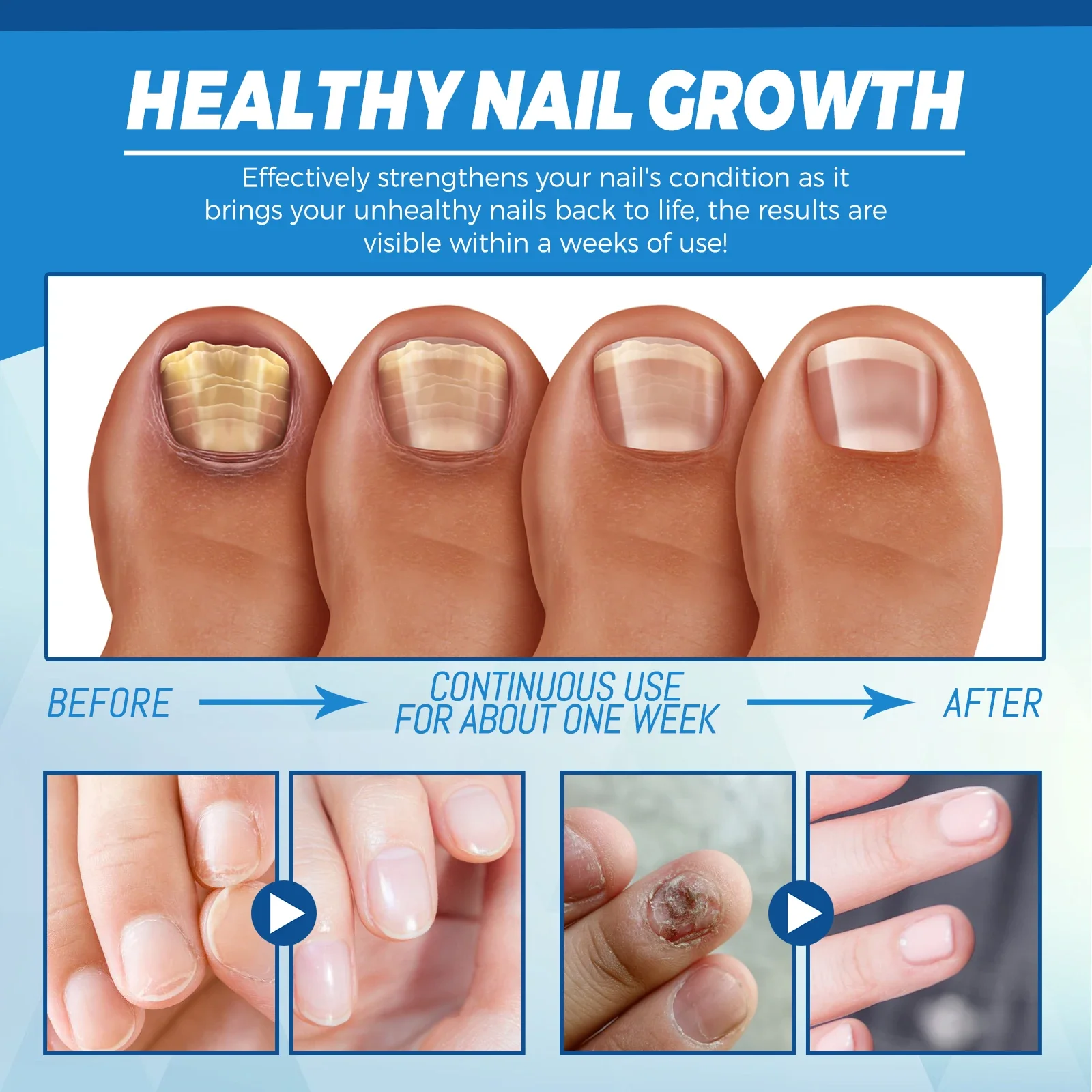 Nail fungus remover Fungal Nail Laser Device Repair Fast Nails Fungus Onychomycosis
