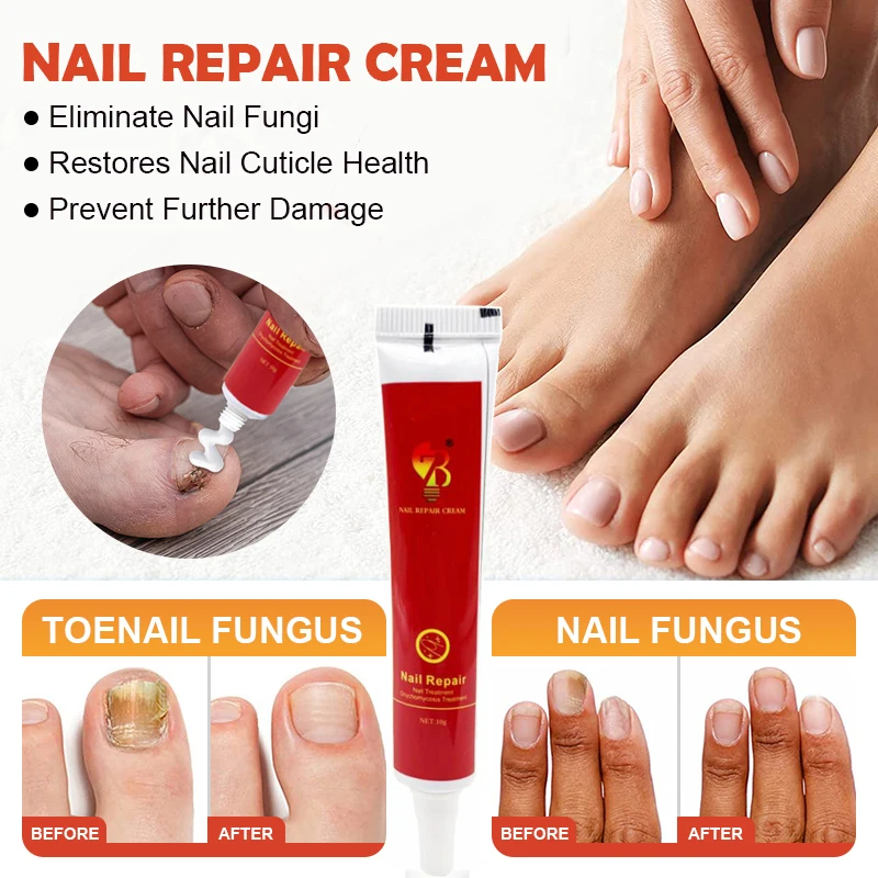 Antibacterial Anti Fungal Cream Nail Fungal Treatment Foot Repair Serum
