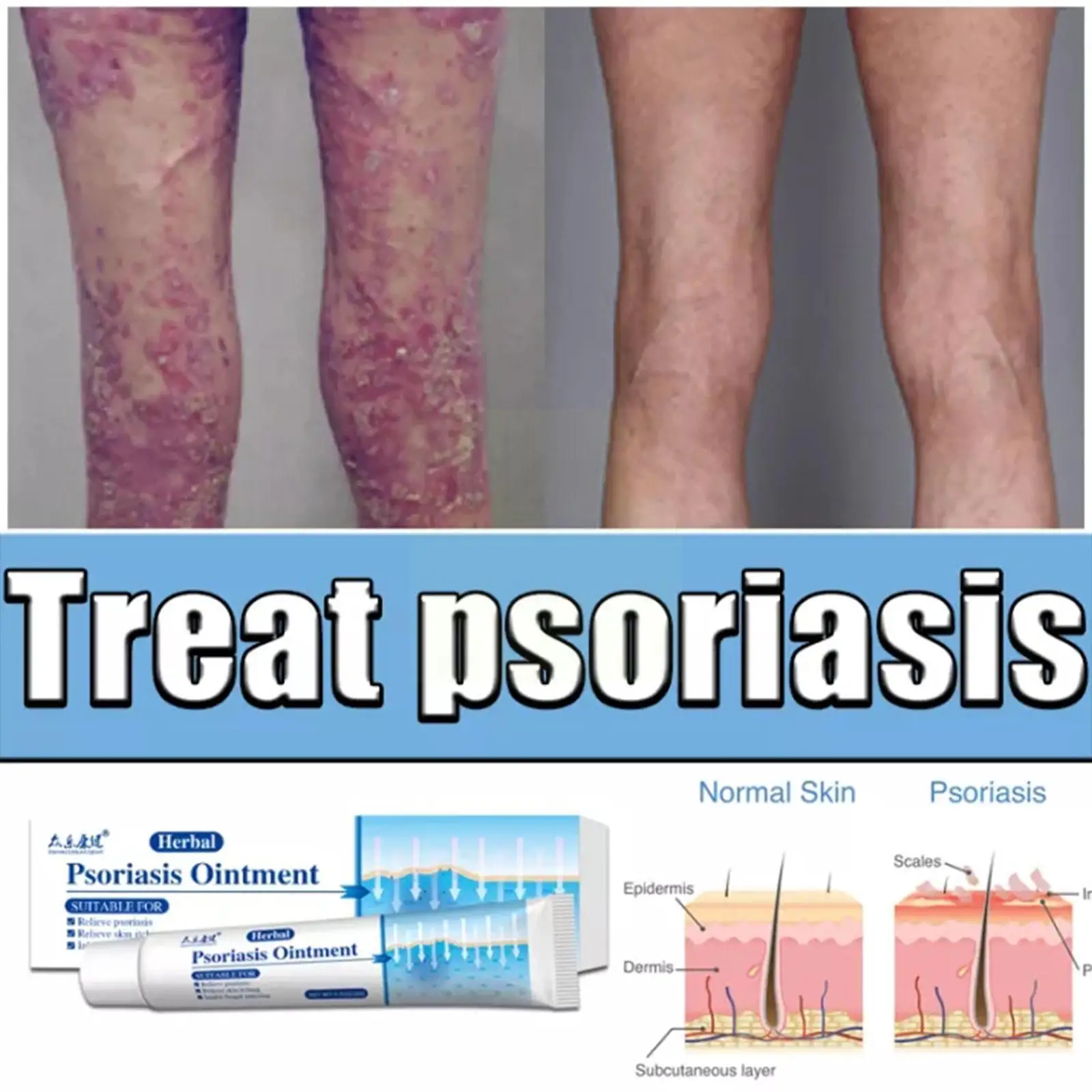 Psoriasis Cream Eczema Ointment Scalp Psoriasis Hand Tinea Foot Odor