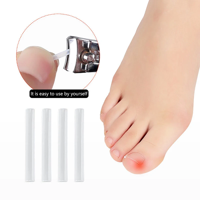 Ingrown Nail Pad Groove Ortho Toenail Corrector Pedicure Paronychia Treatment Bunion Correction Pads Foot Care Tool 10PCS-50PCS toe corrector foot care tool ingrown toenail correction tool foot pedicure tool bunion corrector mens foot care product